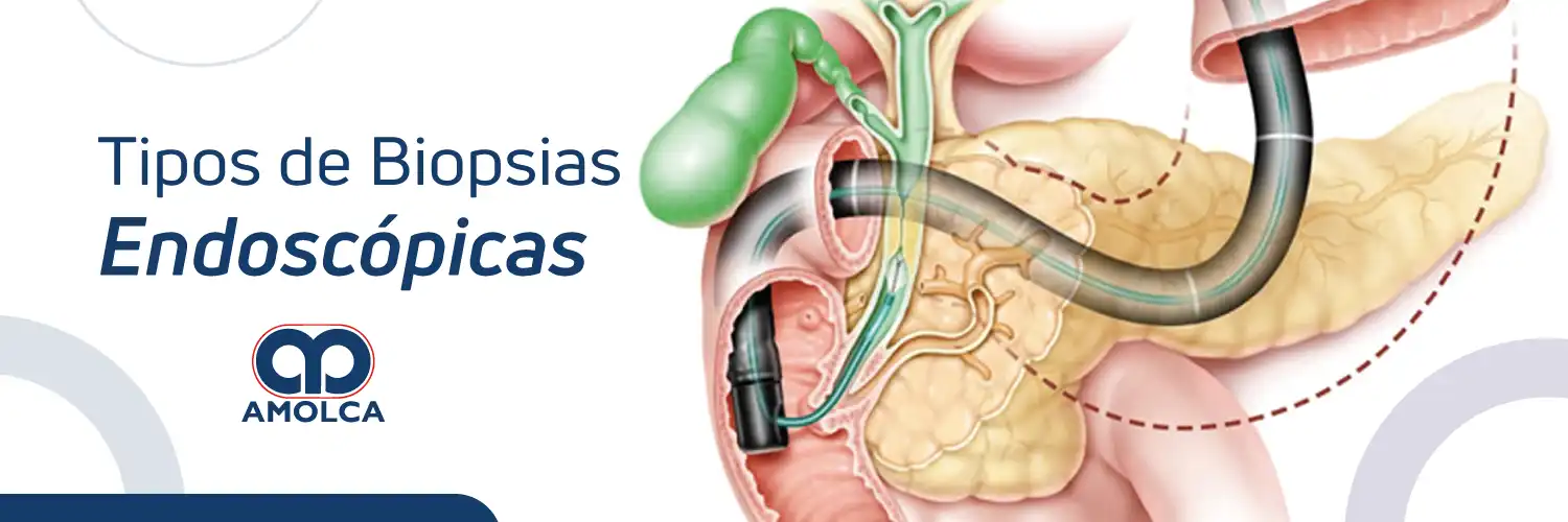 Tipos de Biopsias Endoscópicas