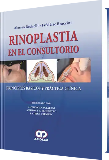 Rinoplastia en el Consultorio