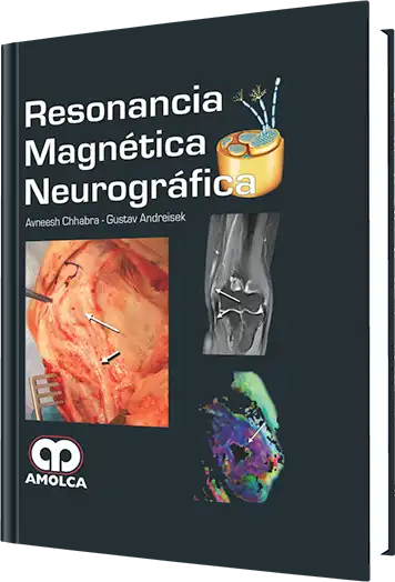 Resonancia Magnética Neurográfica