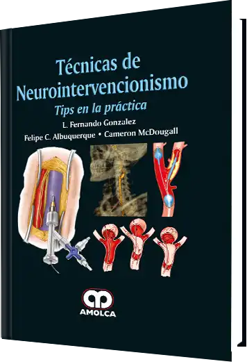 Técnicas de Neurointervencionismo