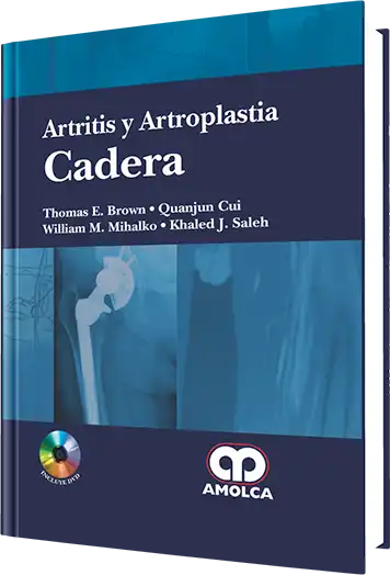 Artritis y Artroplastia. Cadera