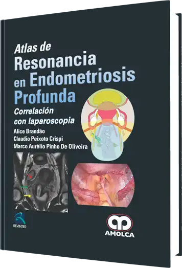 Atlas de Resonancia en Endometriosis Profunda