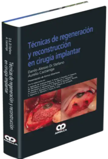 Técnicas de Regeneración y Reconstrucción en Cirugía Implantar