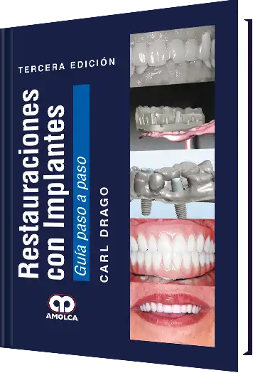 Restauraciones con Implantes. Guía Paso a Paso. 3 Edición