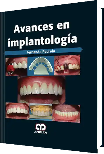 Avances en Implantología